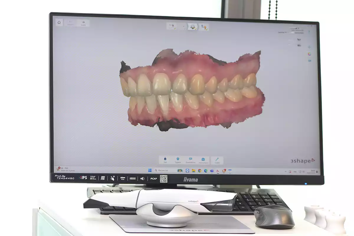 empreinte optique 3D