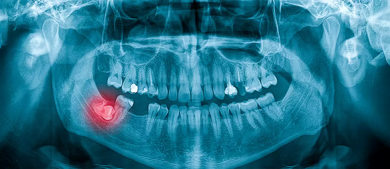 Dents de sagesse / extraction