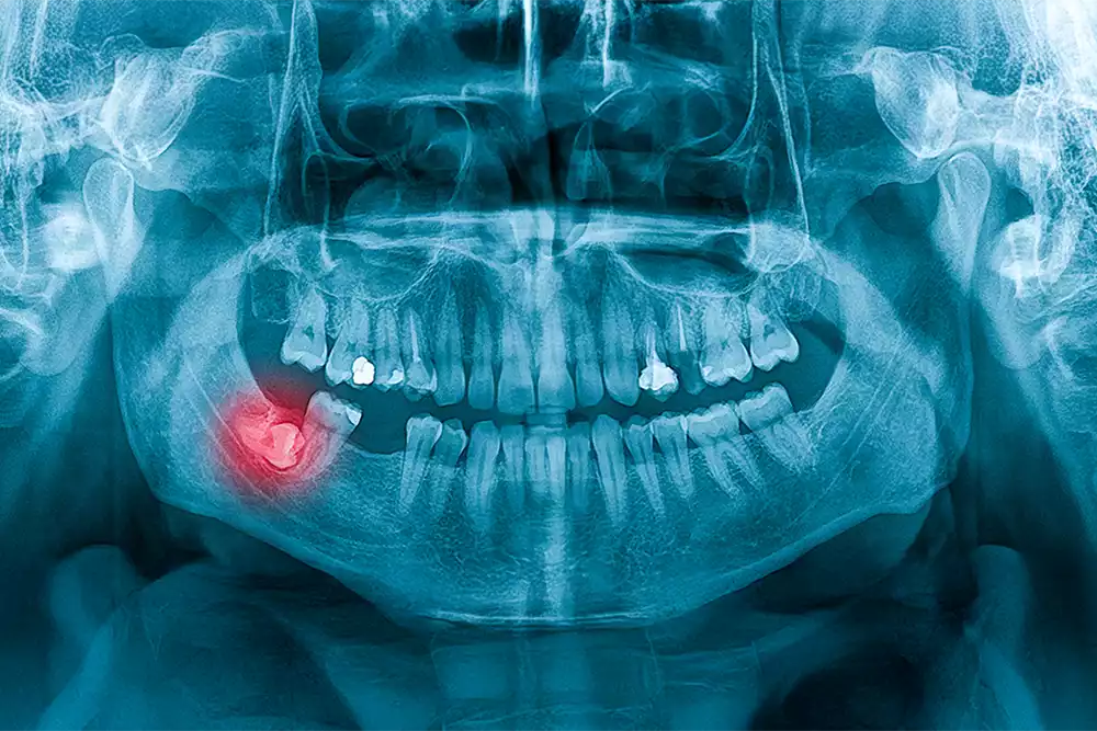 Dents de sagesse / extraction