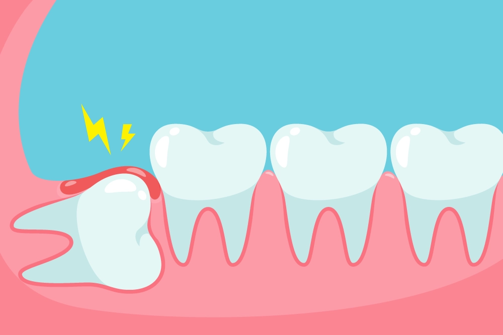 Dents de sagesse / extraction