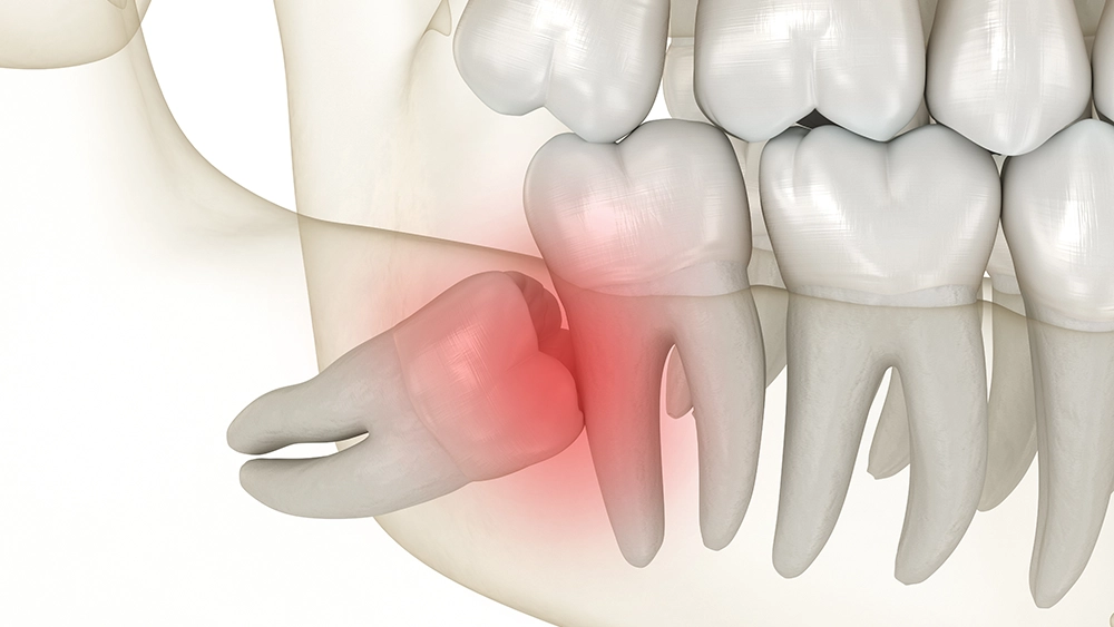 Dents de sagesse / extraction