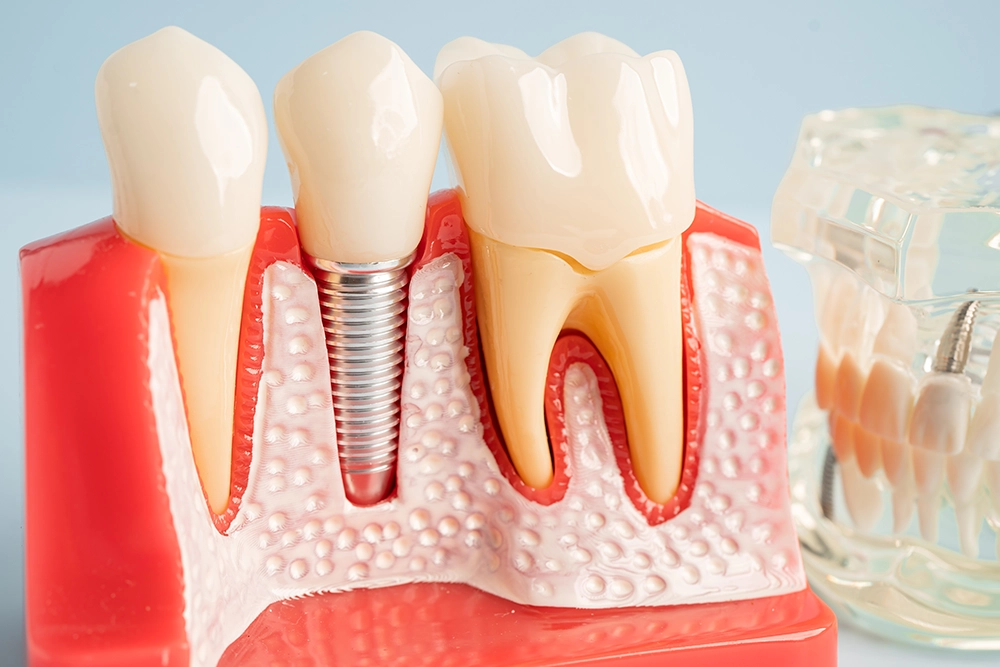 Implants dentaires