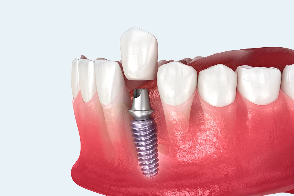 Implants dentaires : protocole